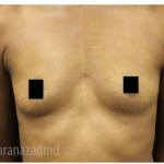 Breast Augmentation Before & After Patient #322