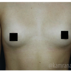 Breast Augmentation Before & After Patient #315
