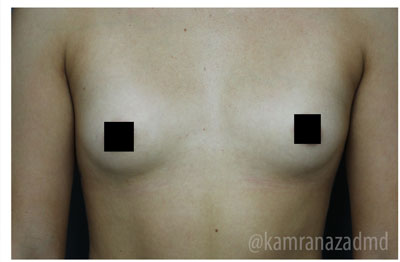 Breast Augmentation Before & After Patient #315