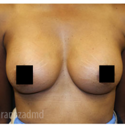 Breast Augmentation Before & After Patient #322