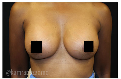 Breast Augmentation Before & After Patient #322