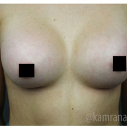 Breast Augmentation Before & After Patient #315