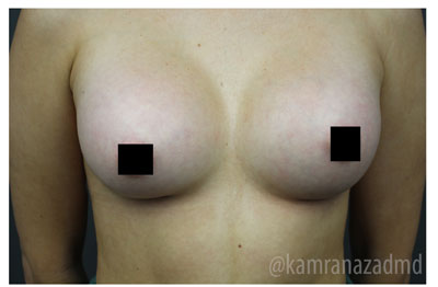 Breast Augmentation Before & After Patient #315