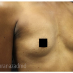 Breast Augmentation Before & After Patient #322