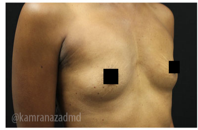 Breast Augmentation Before & After Patient #322