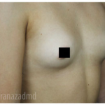 Breast Augmentation Before & After Patient #315
