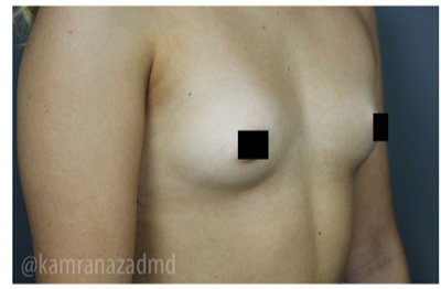 Breast Augmentation Before & After Patient #315