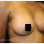 Breast Augmentation Before & After Patient #322