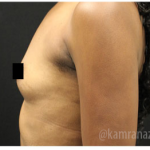 Breast Augmentation Before & After Patient #322