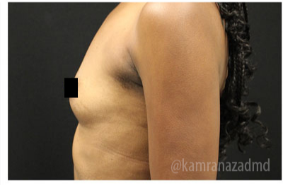 Breast Augmentation Before & After Patient #322