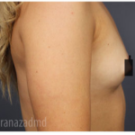 Breast Augmentation Before & After Patient #315