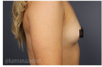Breast Augmentation Before & After Patient #315