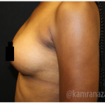 Breast Augmentation Before & After Patient #322