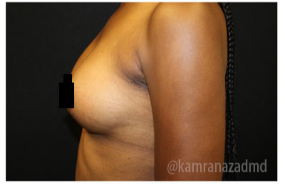 Breast Augmentation Before & After Patient #322