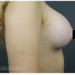 Breast Augmentation Before & After Patient #315