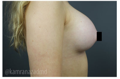 Breast Augmentation Before & After Patient #315