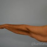 Arm Lift Before & After Patient #1484
