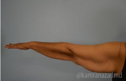 Arm Lift Before & After Patient #1484
