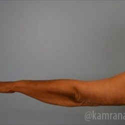 Arm Lift Before & After Patient #1484