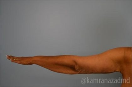 Arm Lift Before & After Patient #1484