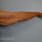 Arm Lift Before & After Patient #1484