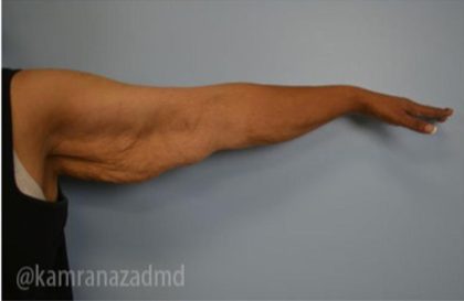 Arm Lift Before & After Patient #1484