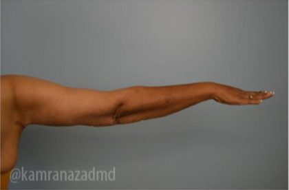 Arm Lift Before & After Patient #1484
