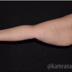 Arm Lift Before & After Patient #1486