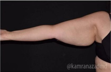Arm Lift Before & After Patient #1486
