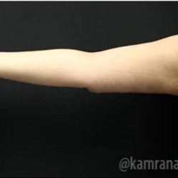 Arm Lift Before & After Patient #1486