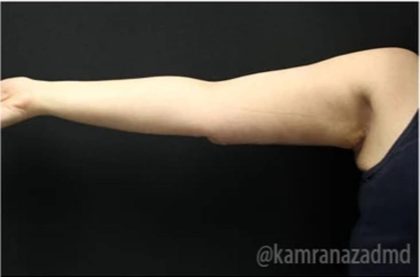 Arm Lift Before & After Patient #1486