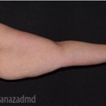 Arm Lift Before & After Patient #1486