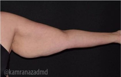 Arm Lift Before & After Patient #1486