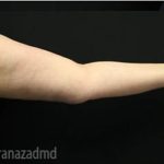 Arm Lift Before & After Patient #1486