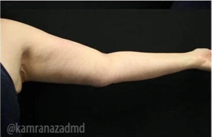 Arm Lift Before & After Patient #1486