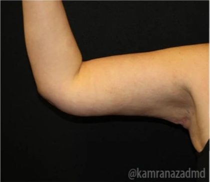 Arm Lift Before & After Patient #1486