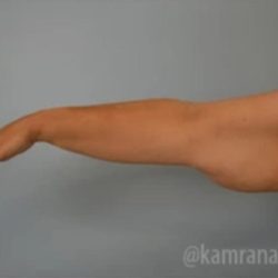 Arm Lift Before & After Patient #1487
