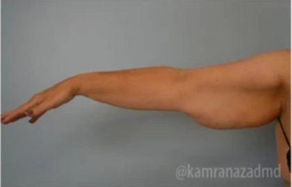Arm Lift Before & After Patient #1487