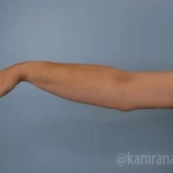 Arm Lift Before & After Patient #1487