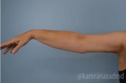 Arm Lift Before & After Patient #1487