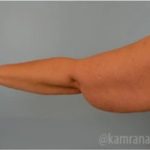 Arm Lift Before & After Patient #1487
