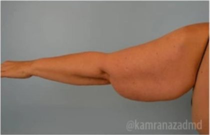 Arm Lift Before & After Patient #1487