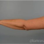 Arm Lift Before & After Patient #1487