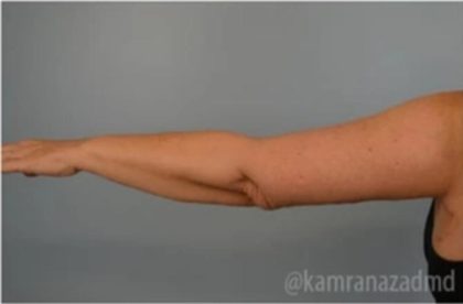 Arm Lift Before & After Patient #1487
