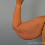 Arm Lift Before & After Patient #1487