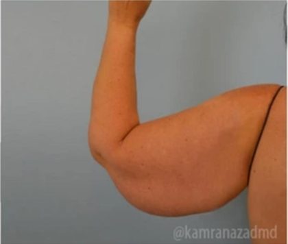Arm Lift Before & After Patient #1487