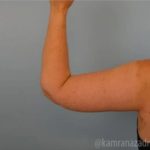 Arm Lift Before & After Patient #1487