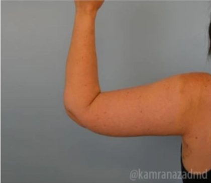 Arm Lift Before & After Patient #1487