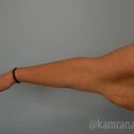 Arm Lift Before & After Patient #1489