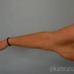 Arm Lift Before & After Patient #1489